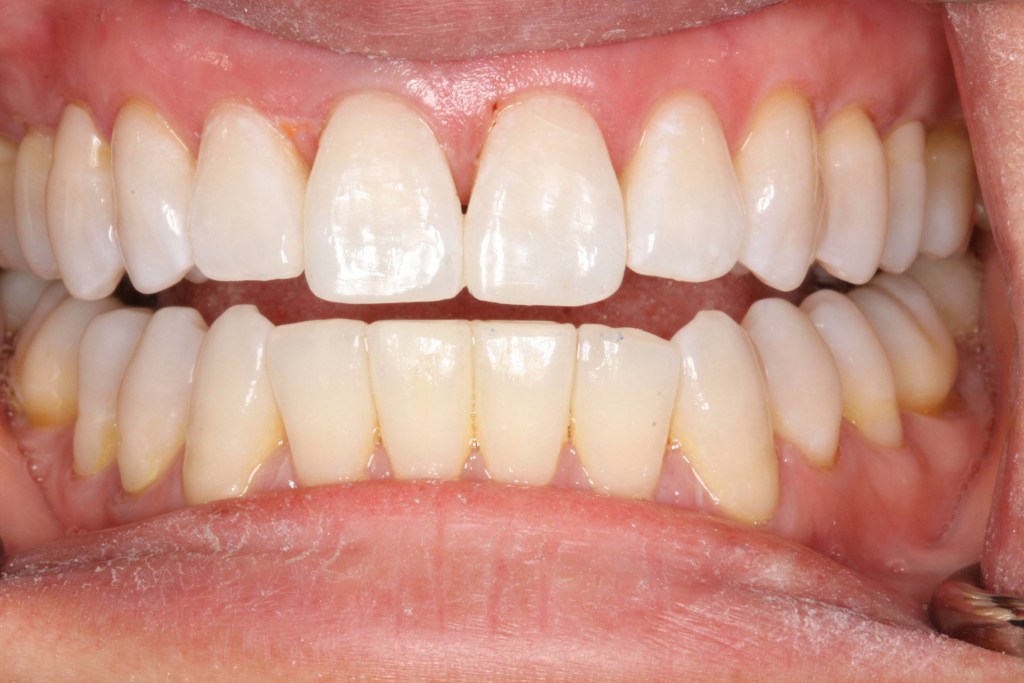 Composite Build Up